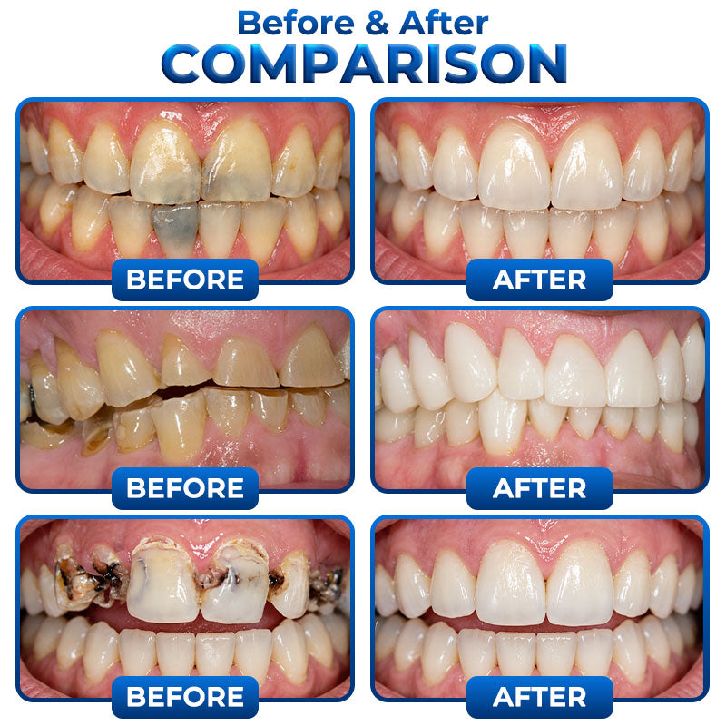 Rolimey® BioFill Cavity-Repair Natural Enamel Filling Gel