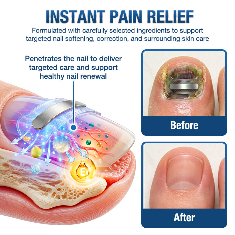 Evolvion® Ingrown Toenail Corrector Nail Renewal Patches