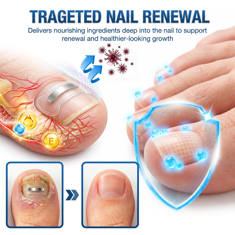 Evolvion® Ingrown Toenail Corrector Nail Renewal Patches