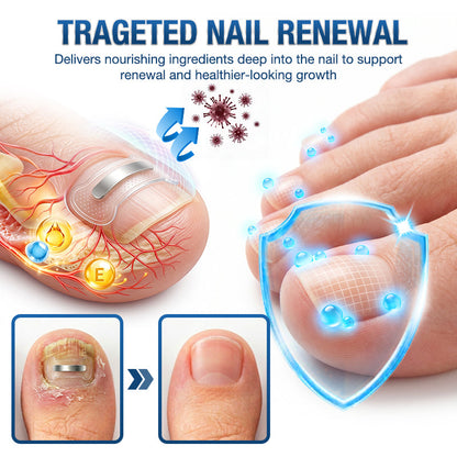 Evolvion® Ingrown Toenail Corrector Nail Renewal Patches