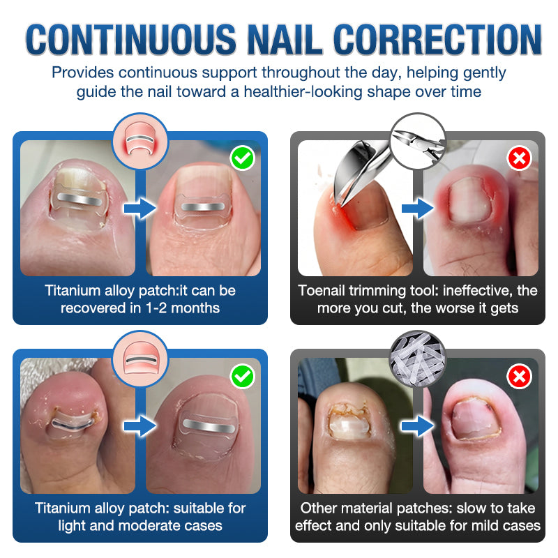 Evolvion® Ingrown Toenail Corrector Nail Renewal Patches