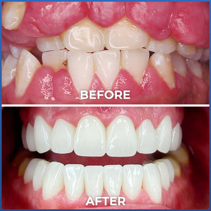 Rolimey® Bio-Probiotic SP-6 Gum Therapy Brightening Dental Toothpaste