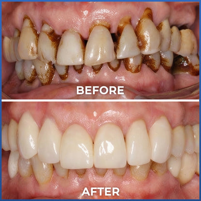 Rolimey® Bio-Probiotic SP-6 Gum Therapy Brightening Dental Toothpaste