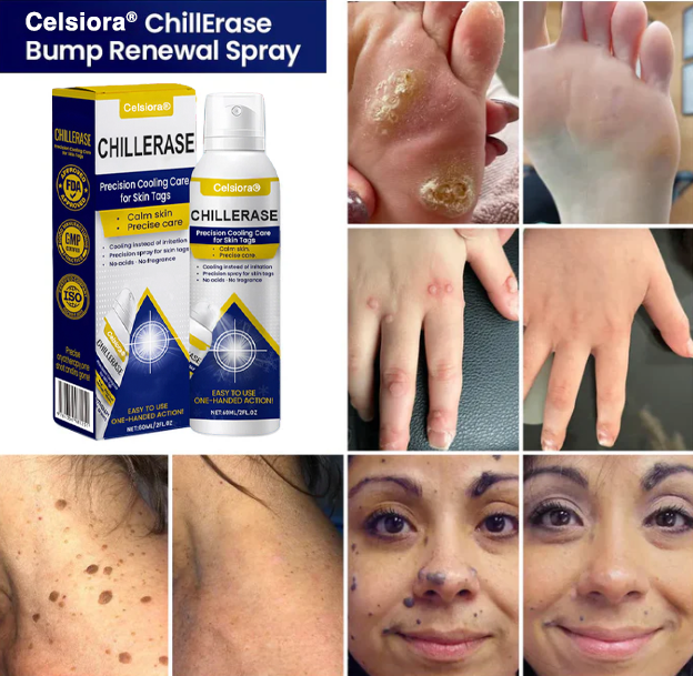 ⭐️Celsiora® ChillErase Cooling Spray for Skin Tags