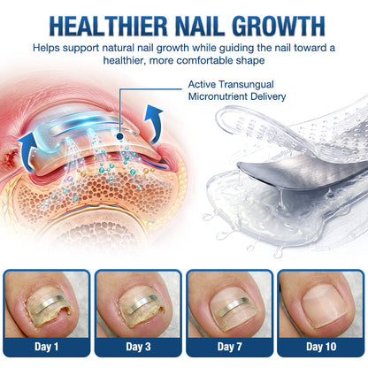 Evolvion® Ingrown Toenail Corrector Nail Renewal Patches