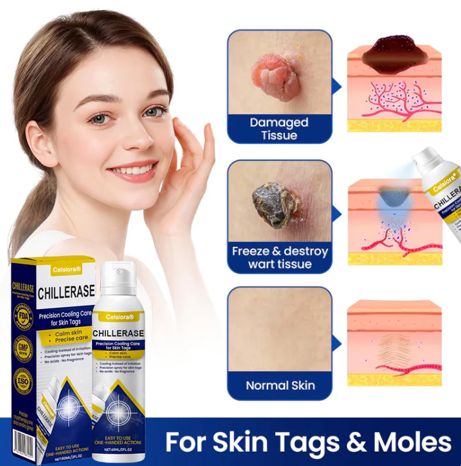⭐️Celsiora® ChillErase Cooling Spray for Skin Tags