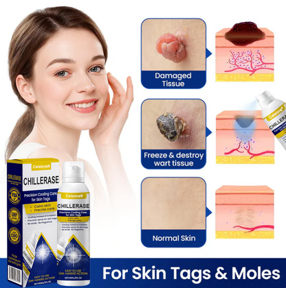 ⭐️Celsiora® ChillErase Cooling Spray for Skin Tags