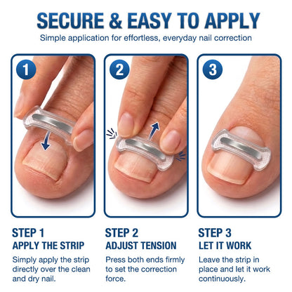 Evolvion® Ingrown Toenail Corrector Nail Renewal Patches