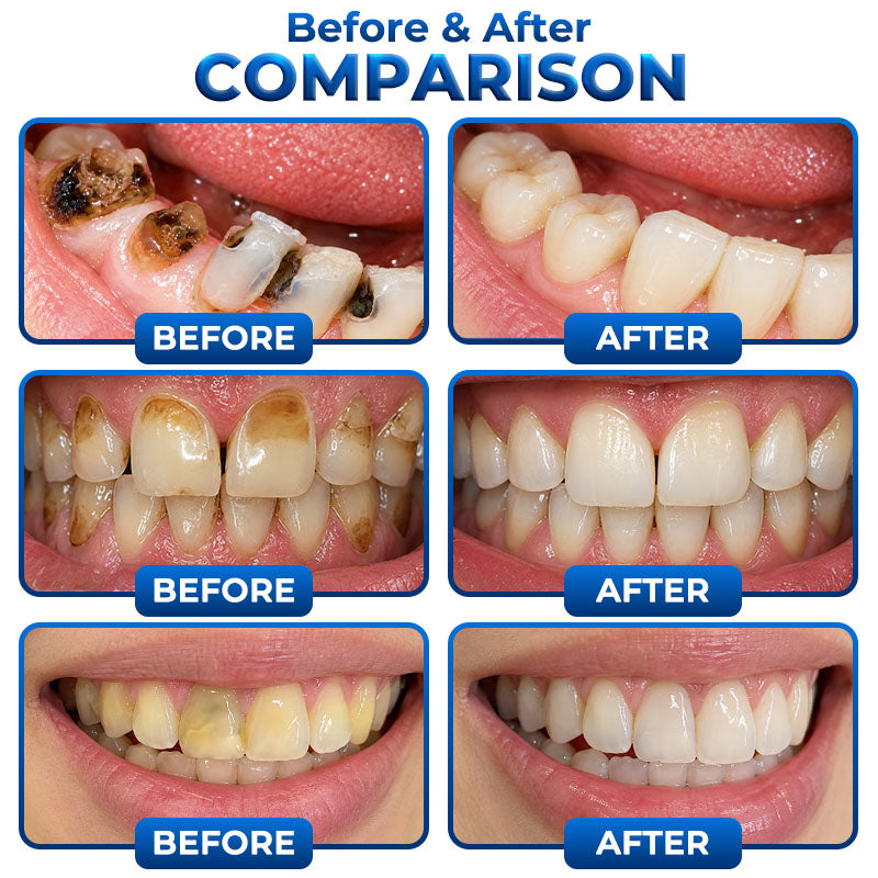 Rolimey® BioFill Cavity-Repair Natural Enamel Filling Gel