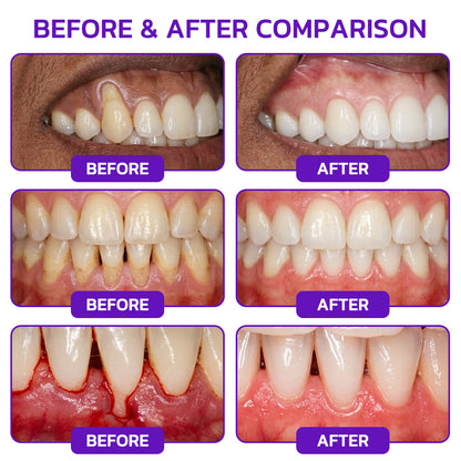 Rolimey® VioCore Bee Venom Gingivitis & Periodontitis Treatment Toothpaste