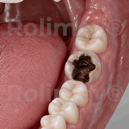 ⭐️Rolimey® BioFill Cavity-Repair Natural Enamel Filling Gel