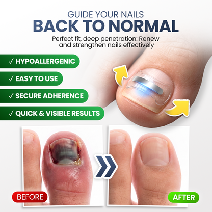 Evolvion® Ingrown Nail Relief & Correction Strips