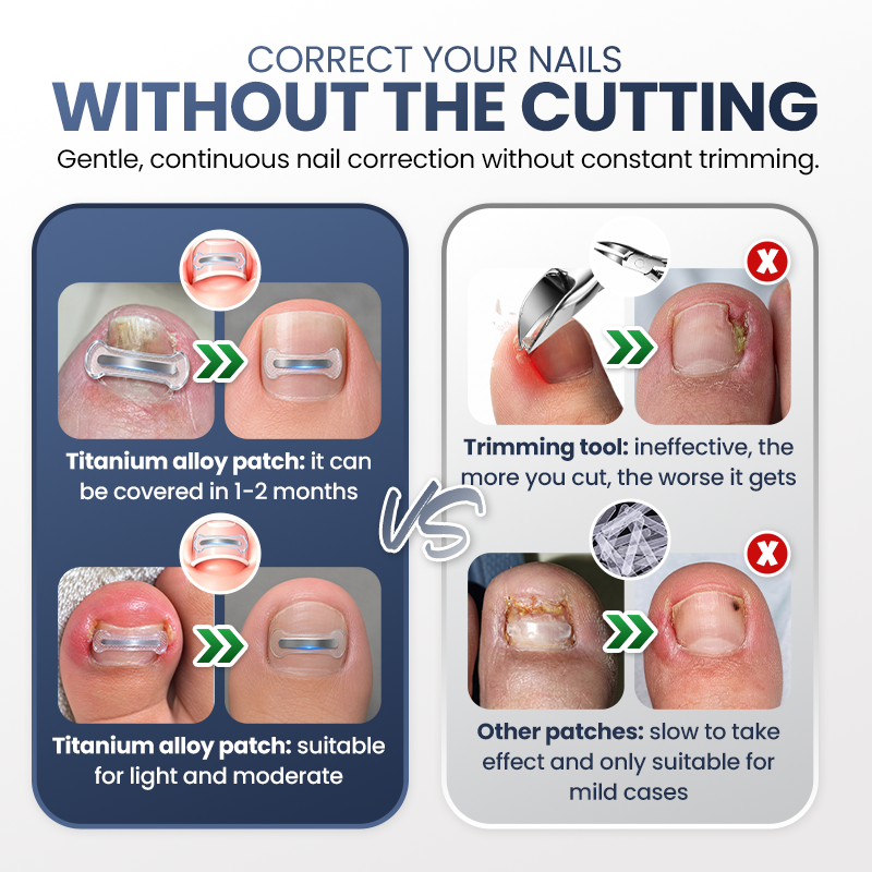 Evolvion® Ingrown Nail Relief & Correction Strips