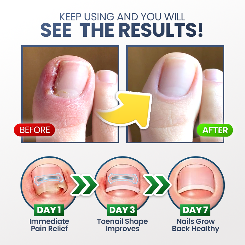 Evolvion® Ingrown Nail Relief & Correction Strips