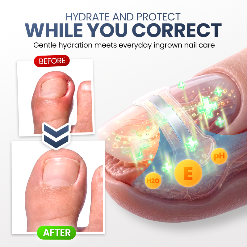 Evolvion® Ingrown Nail Relief & Correction Strips