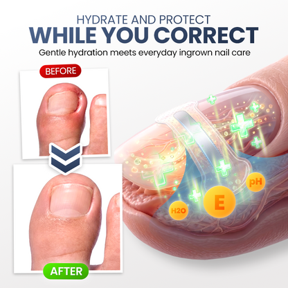 Evolvion® Ingrown Nail Relief & Correction Strips