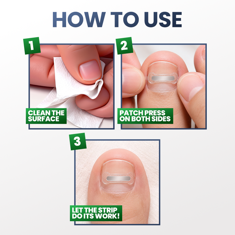 Evolvion® Ingrown Nail Relief & Correction Strips