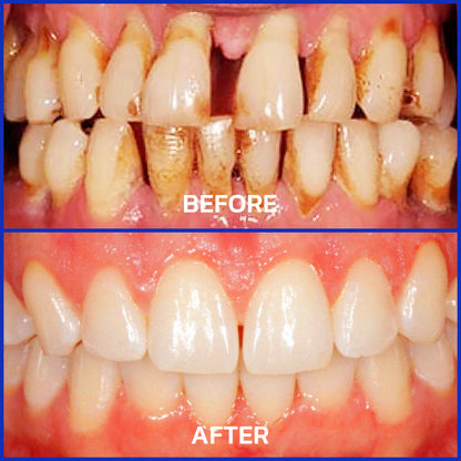 ❤️⭐️Furzero® Focussmile bee venom treatment powder for oral use🦷