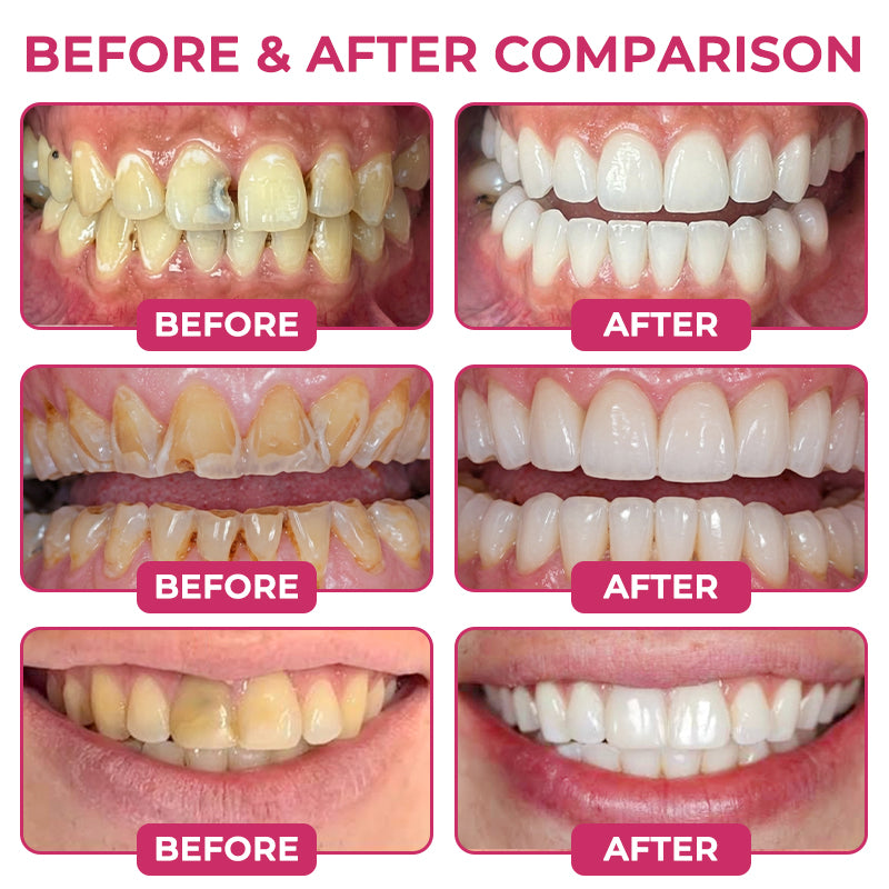 ⭐️Rolimey® DenPerm Cavity-Repair Natural Enamel Filling Gel