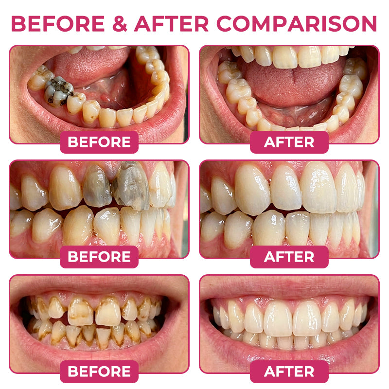 ⭐️Rolimey® DenPerm Cavity-Repair Natural Enamel Filling Gel